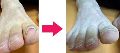 巻き爪変化